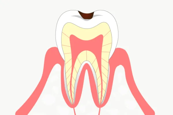 C1（シーワン）エナメル質の虫歯