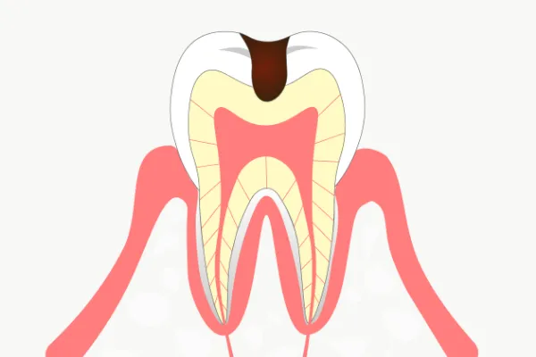 C2（シーツー）象牙質の虫歯