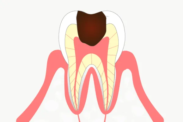 C3（シースリー）歯髄にまで進行した虫歯