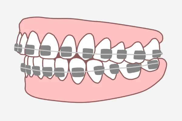 全顎ワイヤー矯正とは